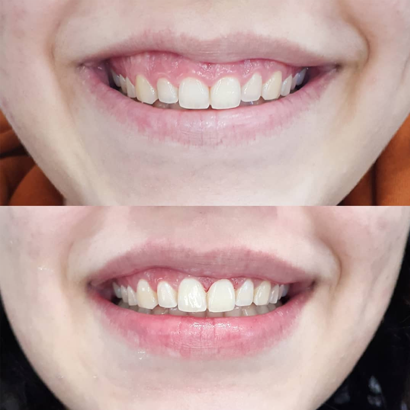 Antes e depois — Gengivoplastia