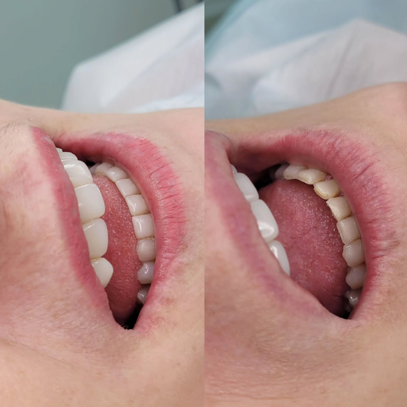 Antes e depois — Recobrimento Radicular